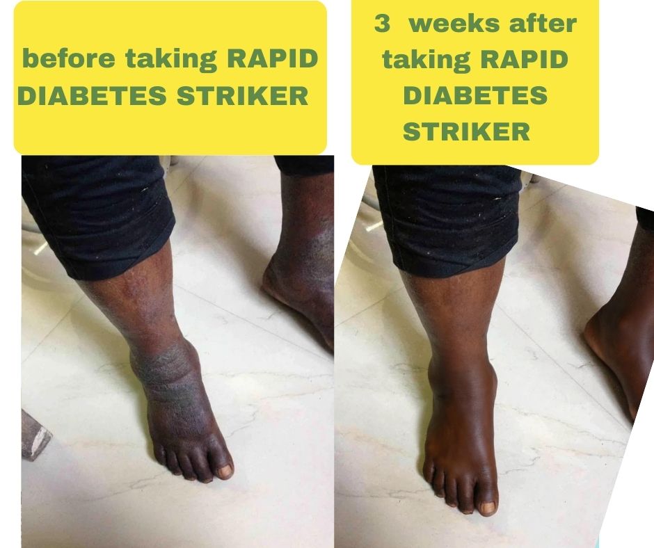 Diabetic foot result after Rapid Diabetes Striker